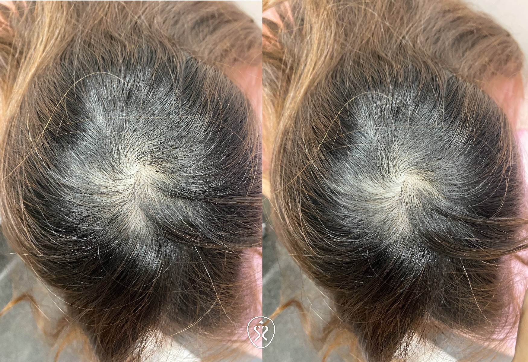 星采星和所提供的複合式生髮，療程疼痛感低，是漸進式生髮育髮療程